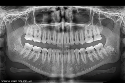 XRay